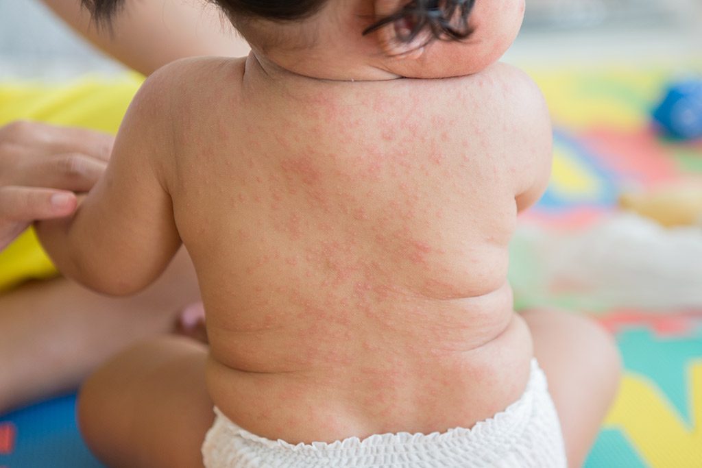 Roseola (Sixth Disease) Symptoms & Causes